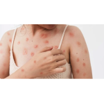 WHO sẽ họp khẩn vì bệnh đậu mùa khỉ